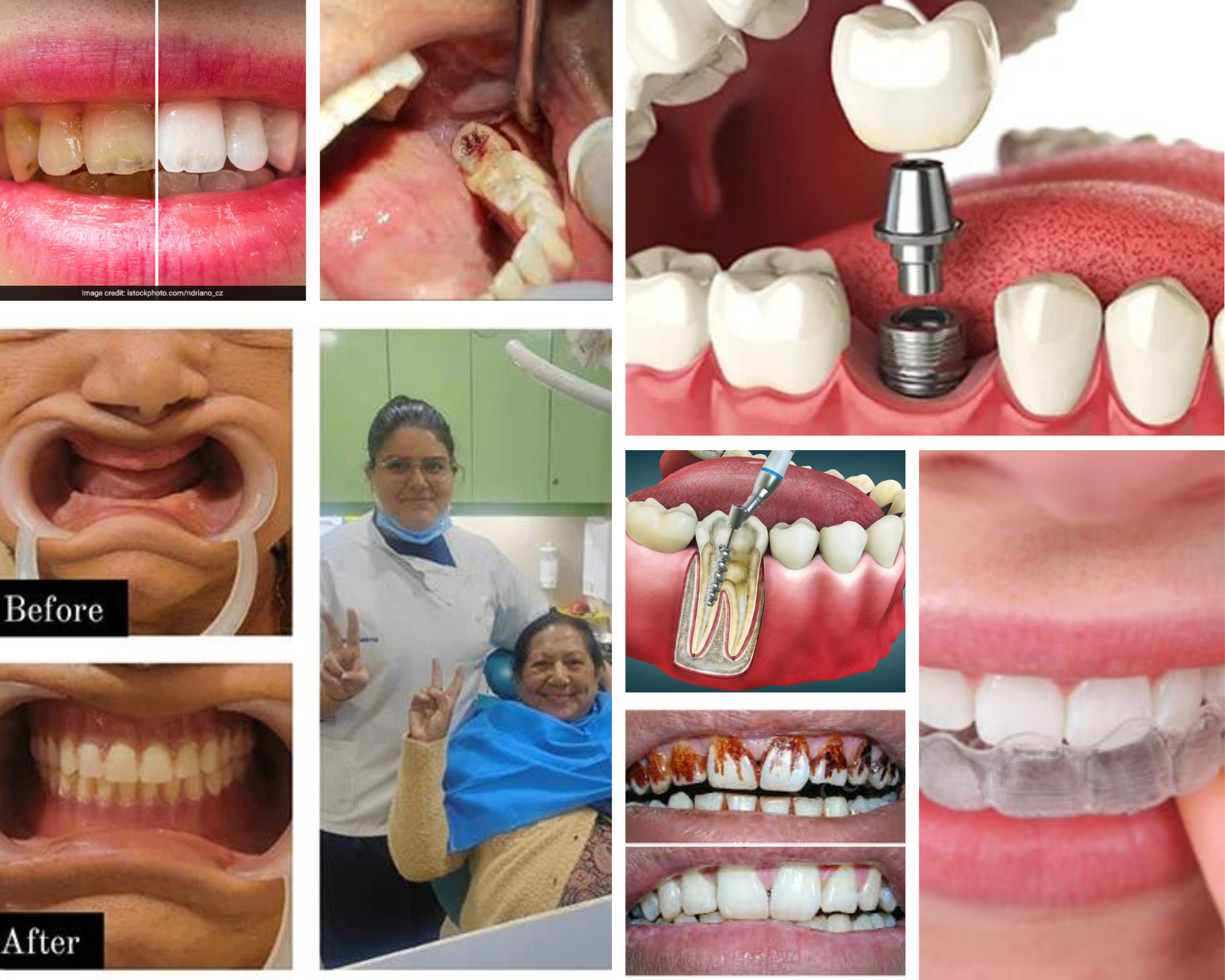 dental braces root canal denture